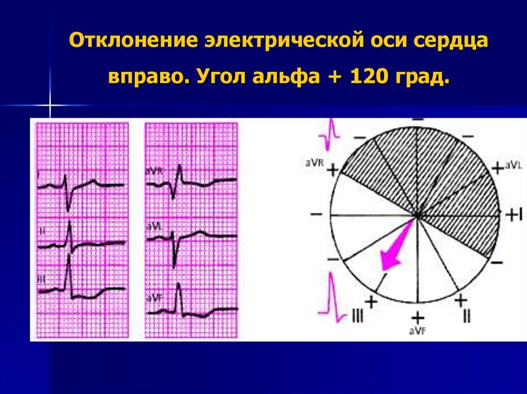 Электрическая ось вправо на ЭКГ. Отклонение оси вправо на ЭКГ. Отклонение ЭОС вправо на ЭКГ. Отклонение электрической оси сердца вправо. Сердце отклонено вправо