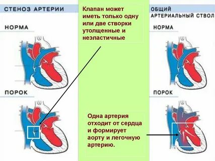 Тест общий артериальный ствол
