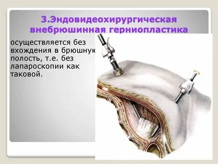 Герниопластика