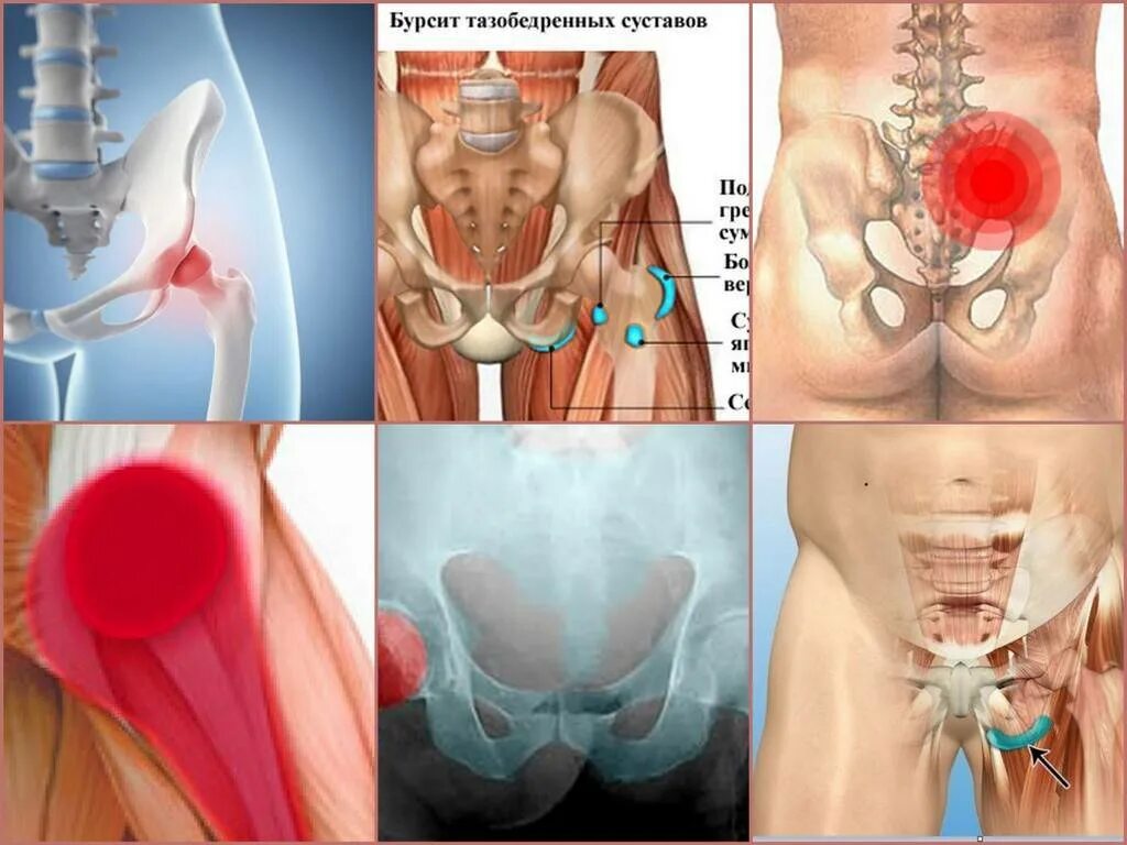 Сильные боли в области таза. Бурсит тазобедренного сустава. Бурсит трохантерит тазобедренного сустава симптомы. Подвздошно-гребешковая сумка тазобедренного сустава. Боль в суставе тазобедренная кости.
