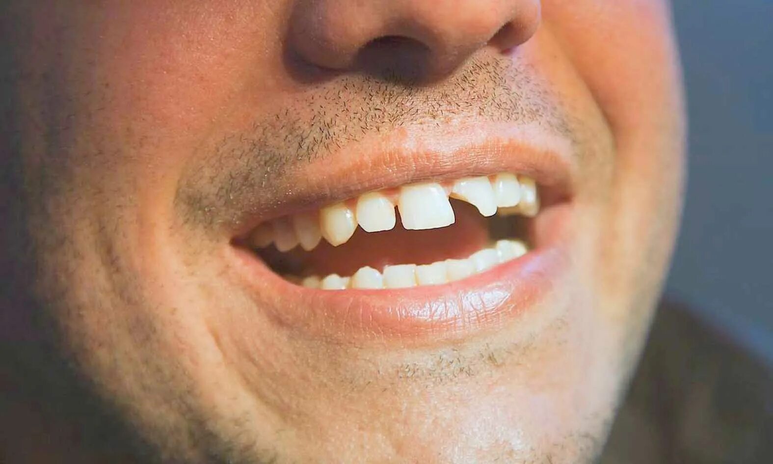 Зубы ию. Зубы ию