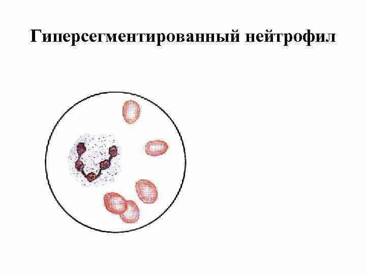 Гиперсегментация ядер нейтрофилов. Пельгеровская аномалия нейтрофилов. ядра нейтрофилов гиперсегментированные. полисегментация нейтрофилов причины.