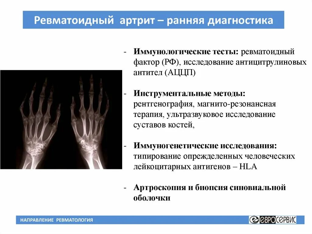 Ранняя стадия ревматоидного артрита. План обследования при ревматоидном артрите. Ведущий симптом ранней диагностики ревматоидного артрита:. Диагностически важным признаком ревматоидного артрита является. Дополнительные методы исследования для ревматического полиартрита.