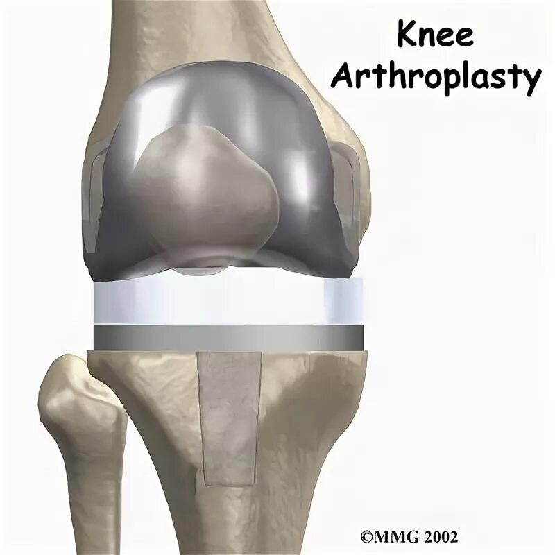 Отек ног после эндопротезирования коленного сустава. Maxx orthopedic эндопротез коленного. эндопротез коленного сустава операция. эндопротезирование коленного сустава ход операции. тотальное эндопротезирование коленного сустава.