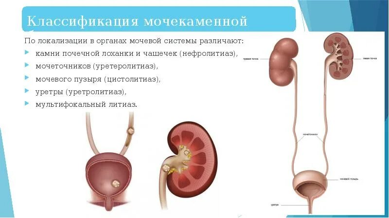 Ощущений мочеточник. Мочевыделительная система почки мочеточники. Камни в мочевыделительной системе. Конкремент мочеточника. Камень из почки мочеточника.