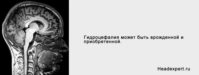 Неокклюзионная гидроцефалия. Гидроцефалия головного мозга мрт. Компьютерная томография головного мозга гидроцефалия. Гидроцефалия головного мозга на кт. Гидроцефалия головного мозга у взрослого на мрт.