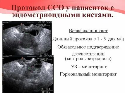 Эндометриоидные кисты отзывы форум
