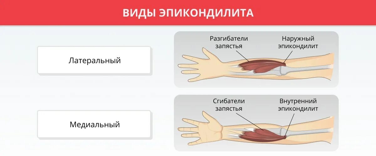 Эпикондилит локтевого сустава код по мкб 10. Медиальный и латеральный эпикондилит. эпикондилит локтевого сустава.