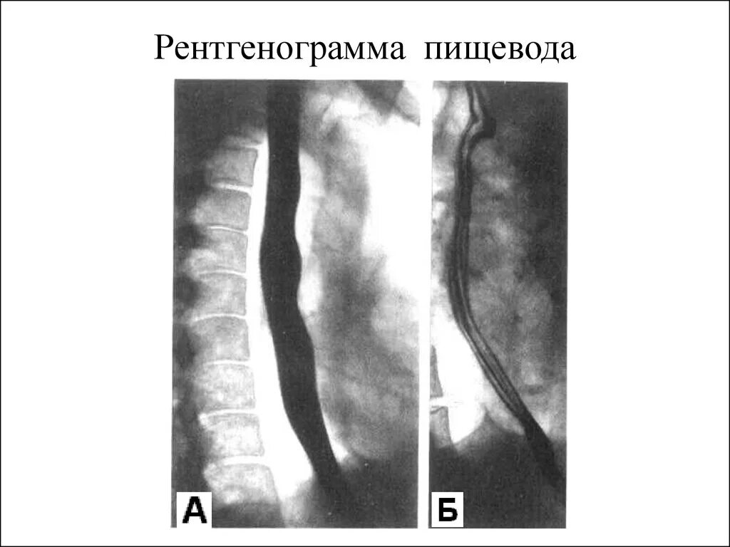 Рентгеноскопия пищевода норма. Контрастирование пищевода рентген. Рефлюкс эзофагит пищевода рентген. Скопия пищевода