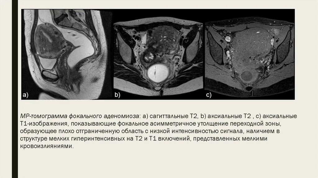 Что такое аденомиоз 1 степени у женщины. Аденомиоз протокол мрт. аденомиоз 3 степени мрт. утолщение переходной зоны матки мрт.