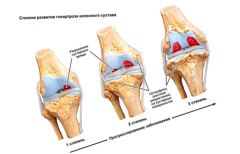 Гонартроз (остеоартроз коленного сустава) симптомы.