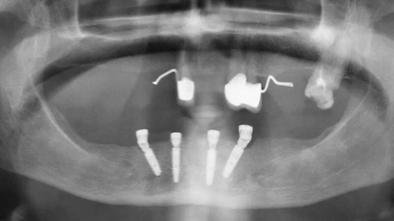 имплантаты а2. имплантаты а2. имплант дентиум. имплантаты а2. имплантаты а2.