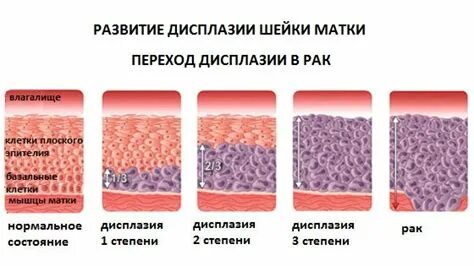 Дисплазия 1 степени шейки матки что это