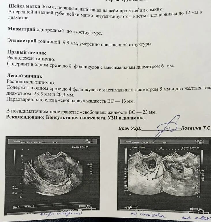 Жидкость в позадиматочном пространстве на узи. Свободная жидкость в позадиматочном пространстве по узи. жидкость в позадиматочном пространстве в незначительном количестве. жидкость позади маточного пространства узи.