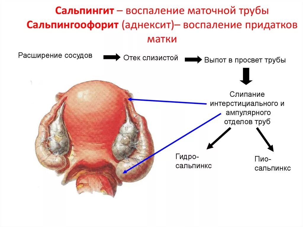 Какая матка при воспалении. Острый сальпингит клиника. Воспаление матки, трубы и яичников. Клиника воспаления маточных труб. Острый Гнойный сальпингоофорит.