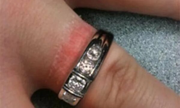 Отпечаток от кольца на пальце. Украшение окислилось. Почему остается след от кольца. От обручального кольца остается след красный. Почему остается след от кольца.