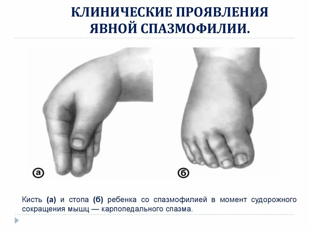 Спазмофилия клинические. Спазмофилия при рахите. синдром спазмофилии у детей. спазмофилия симптом люста. спазмофилия симптом эрба.