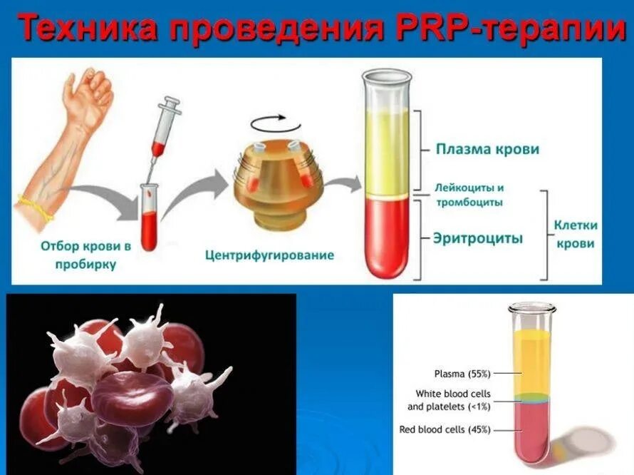 PRP-терапия плазмотерапия. Плазма обогащенная тромбоцитами PRP. PRP терапия в ортопедии и травматологии. PRP плазмолифтинг суставов. Prp эндометрия