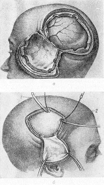 Костно-пластическая Трепанация. Кожно пластическая Трепанация черепа. Трепанация черепа по Оливекрону. Трепанация по Вагнеру Вольфу.