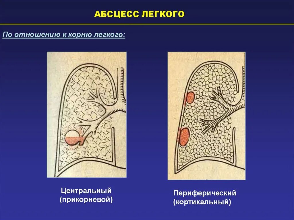 Гнойные абсцессы легких. Периферический абсцесс это. Периферический абсцесс легкого это. Центральный абсцесс легкого. Центральный и периферический абсцесс легкого.