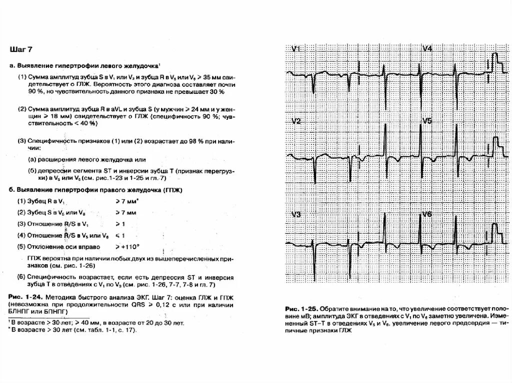 Гипертрофия левого предсердия левого желудочка. Описание ЭКГ гипертрофия левого желудочка. ЭКГ - И ЭХОКГ - признаки гипертрофии левого желудочка.. ЭКГ при гипертрофии левого желудочка при артериальной гипертензии. Критерии гипертрофии левого желудочка на ЭХОКГ.