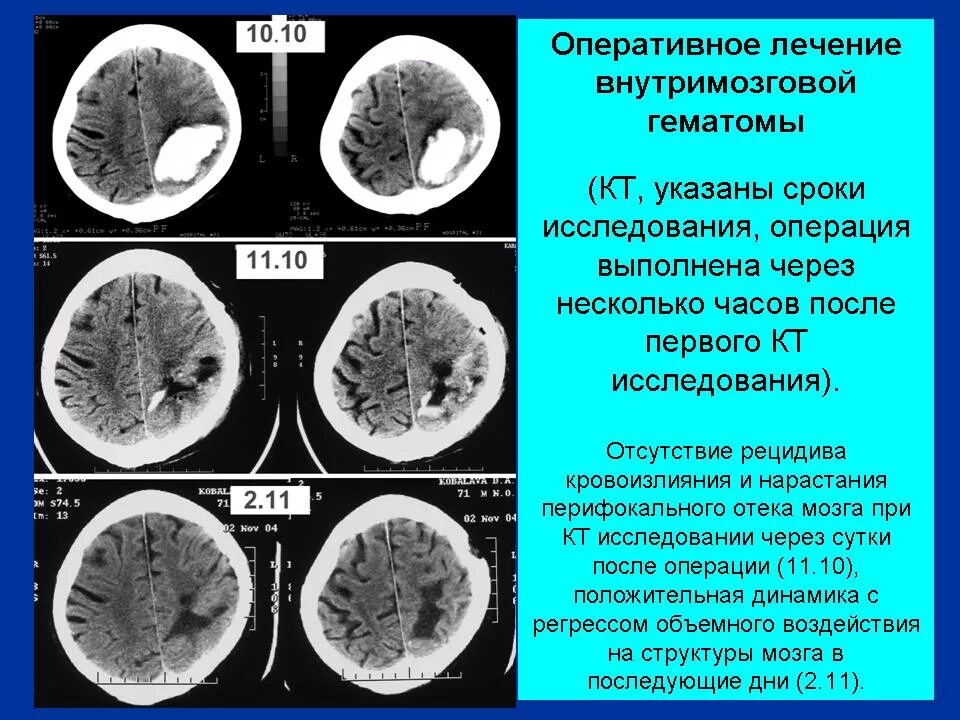 Внутримозговая гематома стадии развития на кт. Геморрагический инсульт внутримозговая гематома. Медиальная гематома при геморрагическом инсульте. Геморрагический инсульт кт.