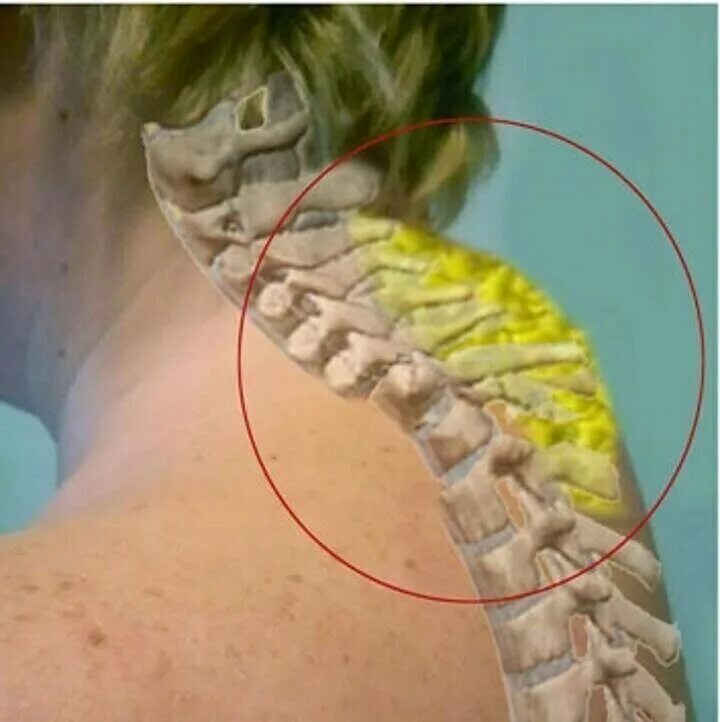 Как убрать шишку на шее отложение солей
