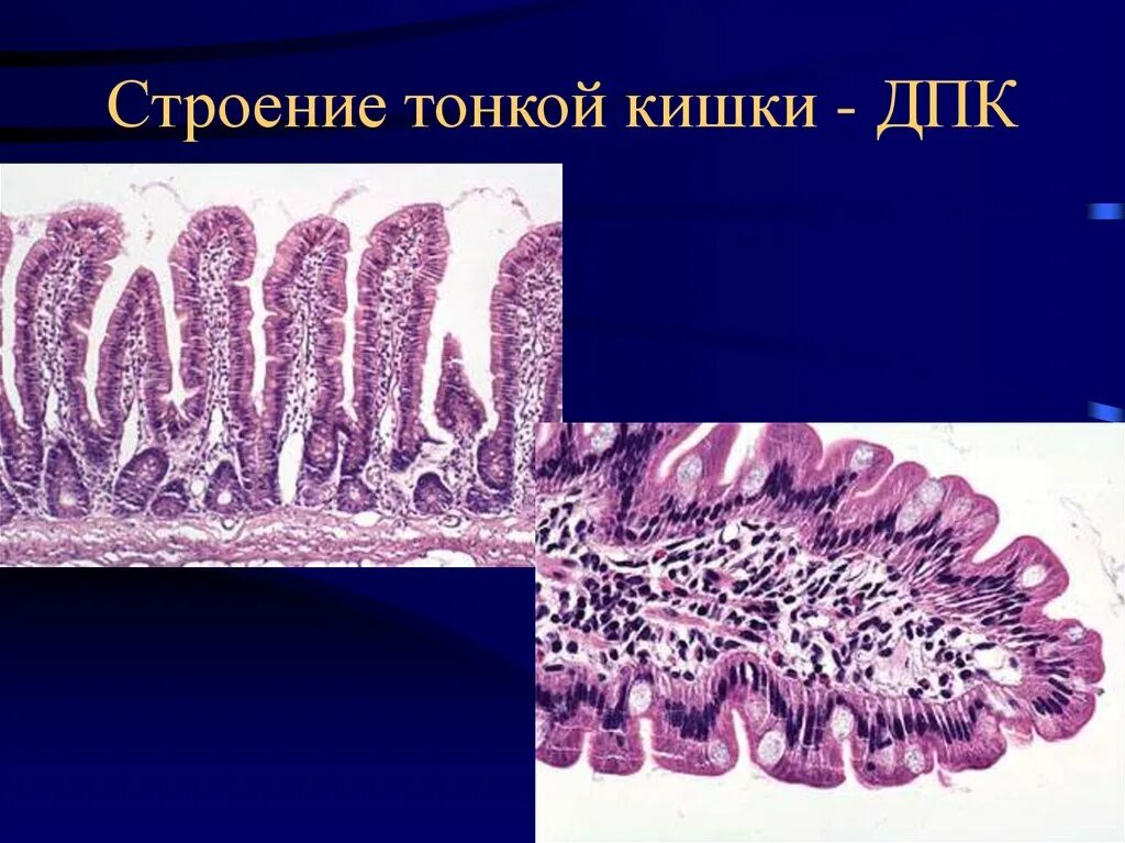 Ткани тонкой кишки. Поражение тонкой кишки. Тонкий кишечник патанатомия. Болезнь крона тонкой кишки патанатомия.