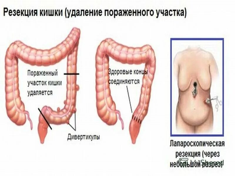Альфа нормикс при дивертикулезе сигмовидной кишки. Альфа нормикс при дивертикулезе сигмовидной кишки