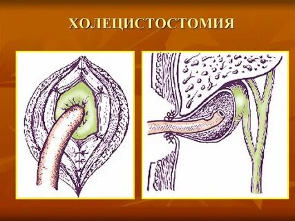 Желчные свищи