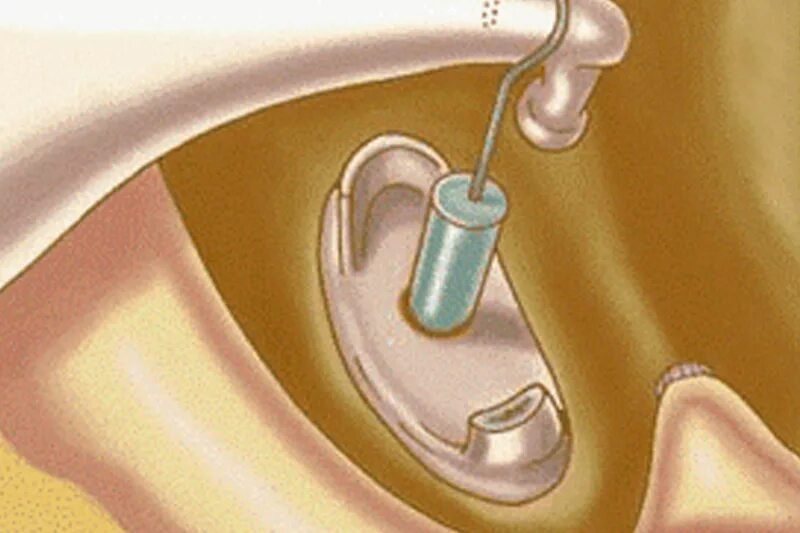 Отосклероз уха операция. Отосклероз стапедопластика. Стапедопластика уха операция. Стапедопластика протез.
