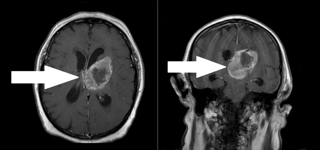 Глиобластома головного мозга на кт и мрт. Глиома головного мозга мрт. Есть рак головы