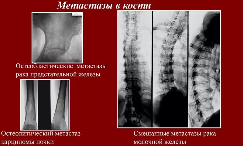 Остеобластические метастазы в костях. Метастатические опухоли костей. При метастазах в костях.