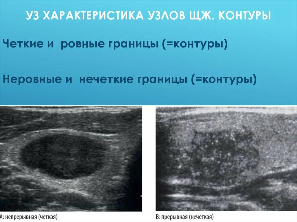 Гиперэхогенным округлым образованием. Гипоэхогенность щитовидной железы. Гипоэхогенный контур узла щитовидной железы. Гипоэхогенный узел щитовидной железы что это такое. Анэхогенный узел щитовидной железы.