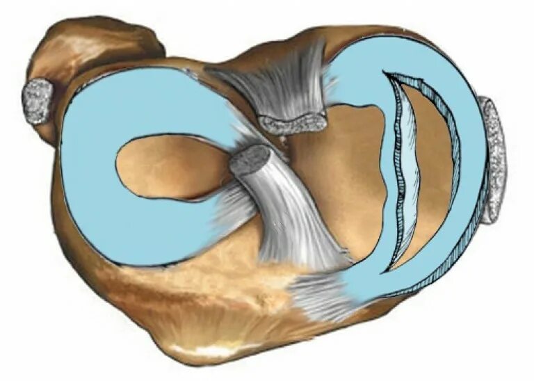 Передний рог коленного сустава. Разрыв мениска ручка лейки. Разрыв мениска по типу ручки лейки. Повреждение мениска коленного сустава. Разрыв мениска коленного сустава ручка лейки.