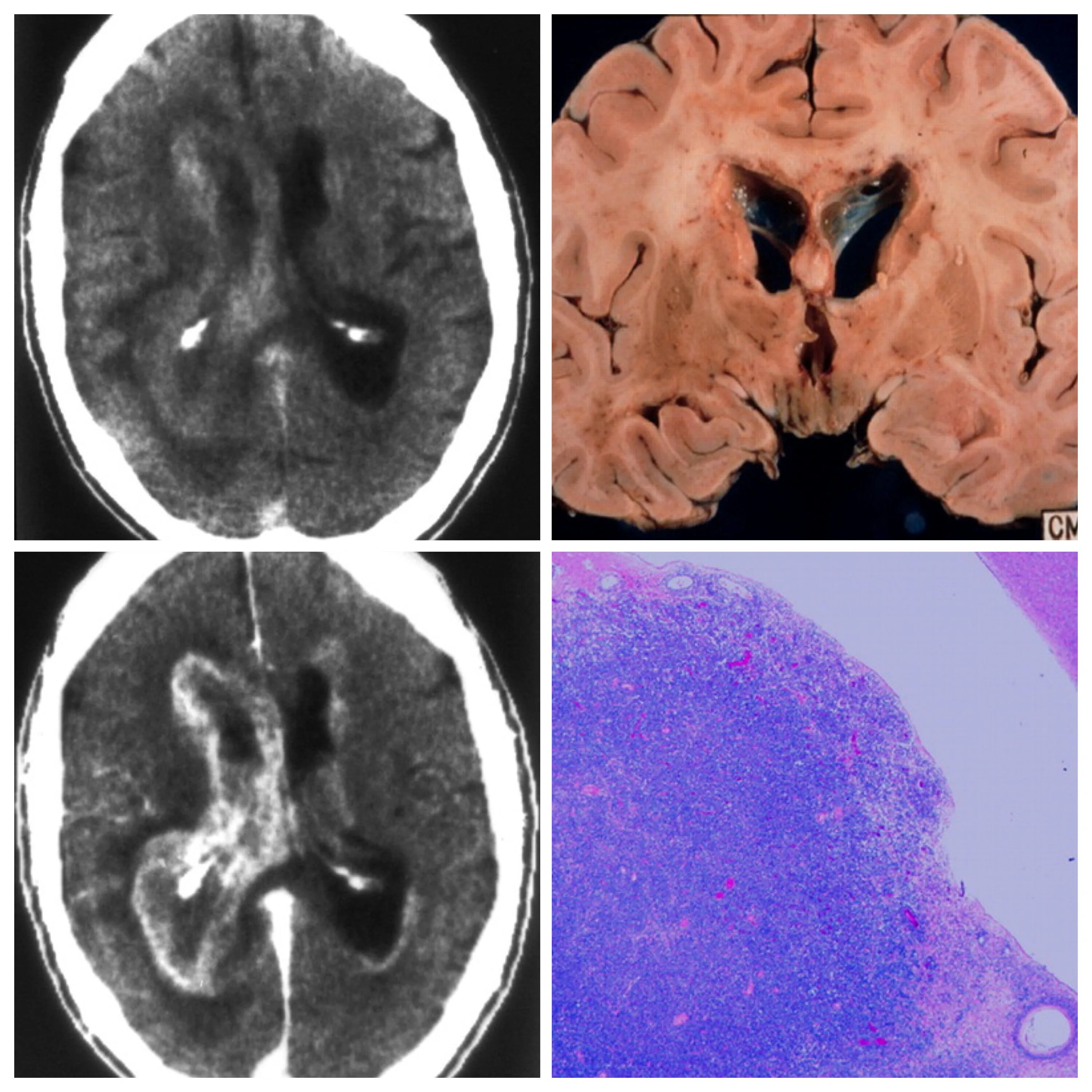 контрастное усиление при кт. перивентрикулярное кровоизлияние. накопление контраста при мрт. накопление контраста при мрт. тип накопления контрастного вещества мрт.