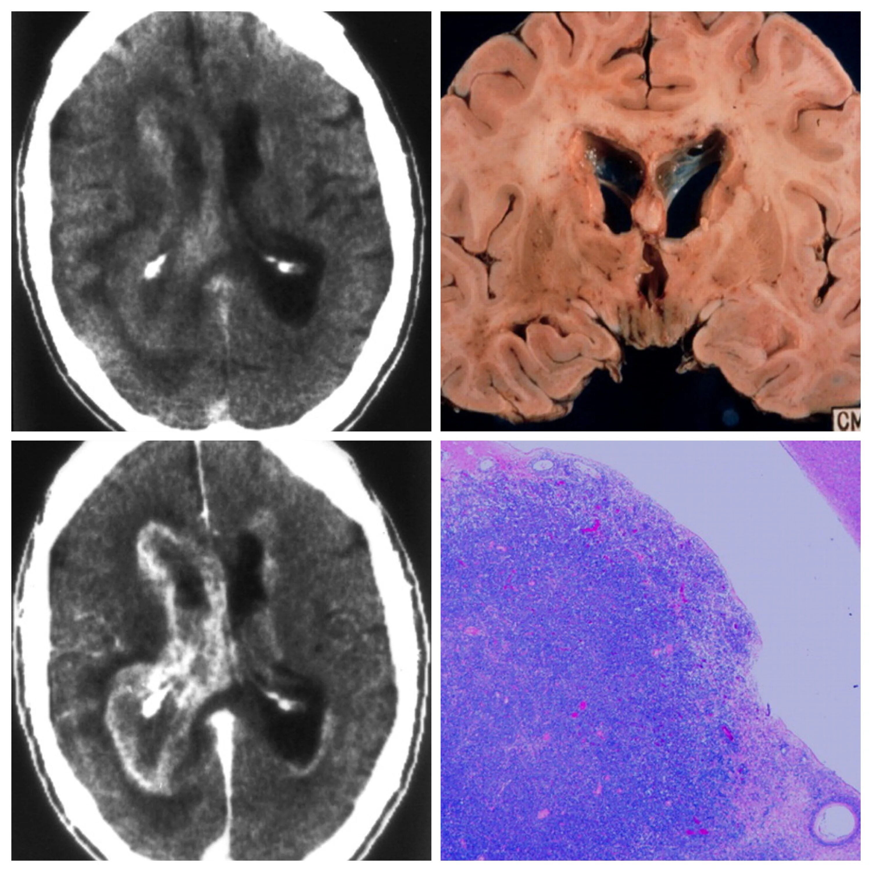 Перивентрикулярное кровоизлияние на кт. Кровоизлияние в желудочки мозга. Перивентрикулярное кровоизлияние мрт. Накопление контраста на мрт.