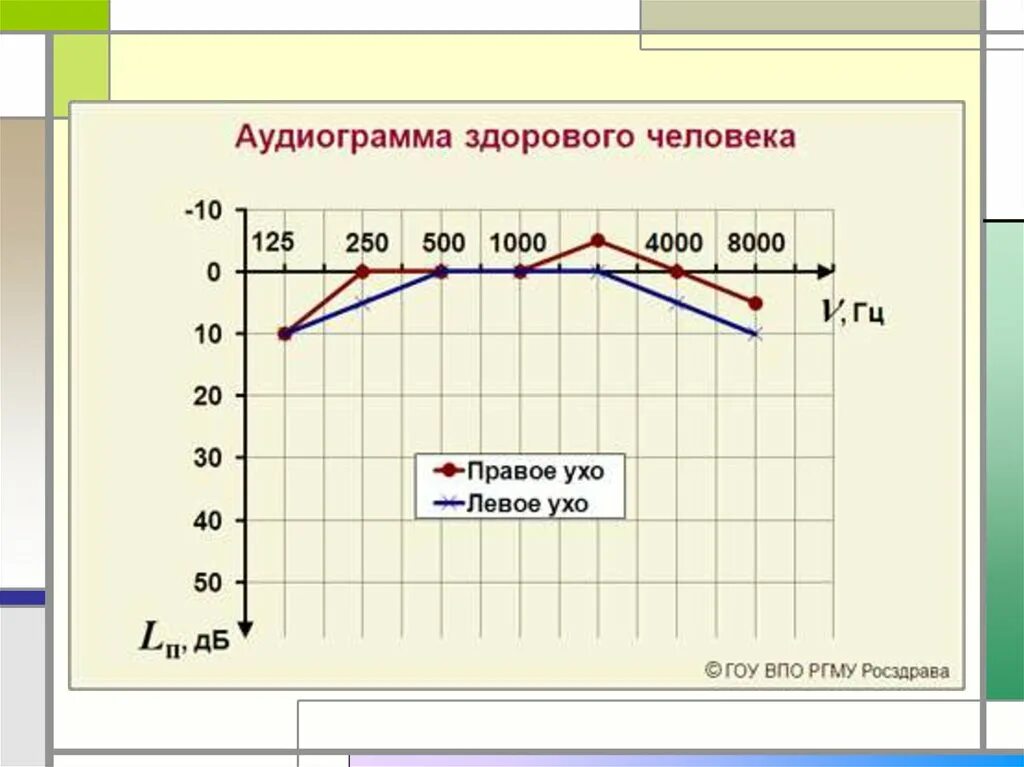 Расшифровка аудиометрии слуха норма. Аудиограмма здорового человека норма. Аудиограмма слуха расшифровка таблица норма. Тональная пороговая аудиограмма норма. Аудиограмма норма