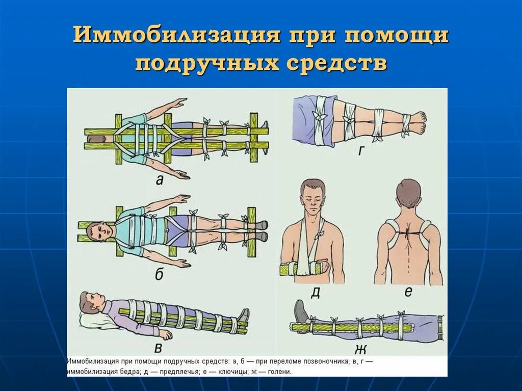 Подручные средства медицинской помощи. Транспортная иммобилизация военнослужащих. Перелом позвоночника иммобилизация. Иммобилизация при травмах конечностей. Иммобилизация при переломе.