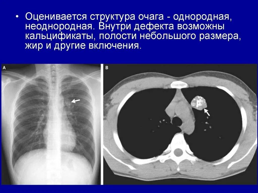 Кальцинаты в лёгких на кт. Доброкачественные опухоли легких гамартома. Полостные образования в легких