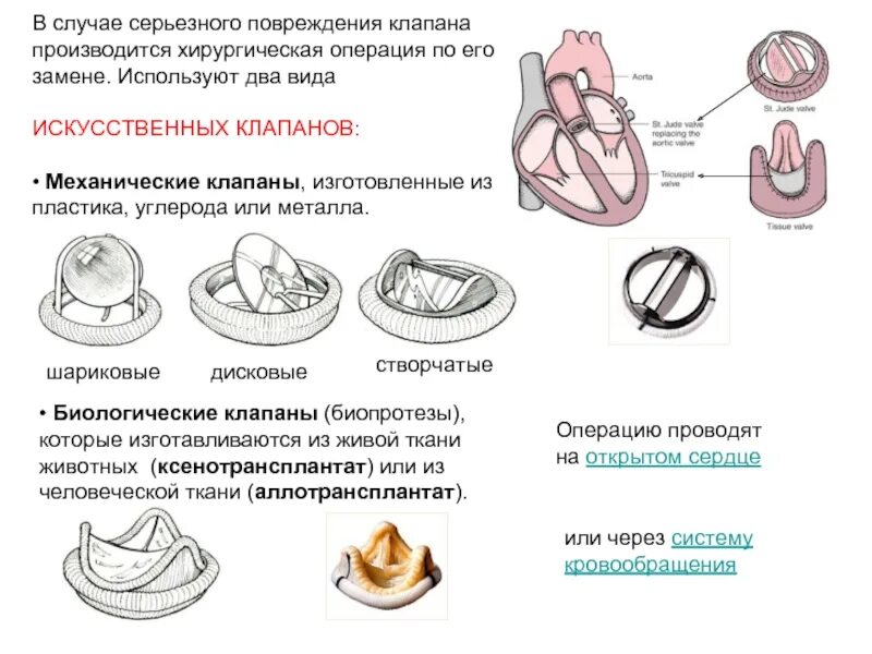 Биологический протез аортального клапана. Биологические искусственные клапаны сердца. Механический протез аортального клапана. Аортальный биологический клапан сердца.