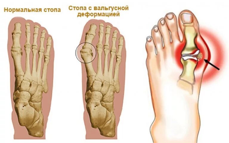 Растущая кость на большом пальце. Вальгусная деформация кости стопы. Вальгусная деформация 1 пальца стопы. Варусная деформация большого пальца стопы. Вальгусная деформация 1 плюснефалангового сустава.