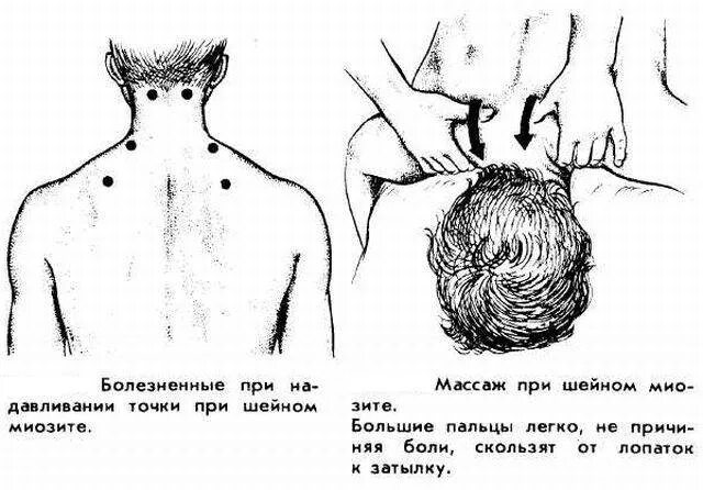 Массаж при орви. Точечный массаж при миозите шеи. Миозит мышц шеи симптомы. Миозит воротниковой зоны. Миозит воспаление мышц шеи.