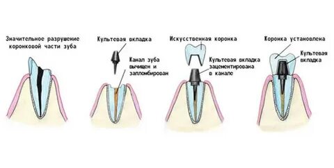 Штифт вкладка в зуб