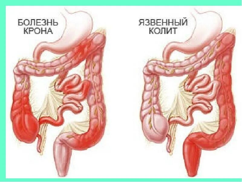 Илеоколит. Язвенный колит колоноскопия. Язвенный колит и болезнь крона.