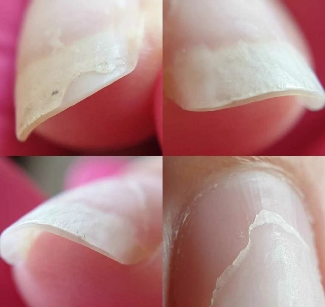 Гель отходит от кончика ногтя. Отлоение ногти от гель лак. Отслойка материала на ногтях.