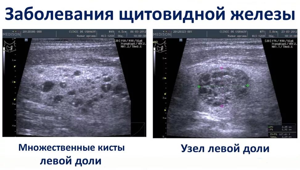 Кистозное образование щитовидной железы УЗИ. Коллоидные кисты щитовидной железы на УЗИ. Раковый узел в щитовидной железе УЗИ. Коллоидный узел щитовидной железы на УЗИ. Лечение диффузно кистозной