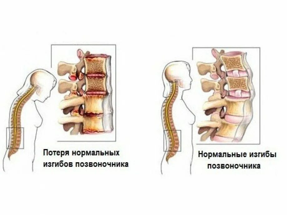 Болезнь Бехтерева грудного отдела позвоночника. Болезнь Бехтерева классификация. Анкилозирующий спондилит болезнь Бехтерева. Болезнь Бехтерева Позвоночный столб.