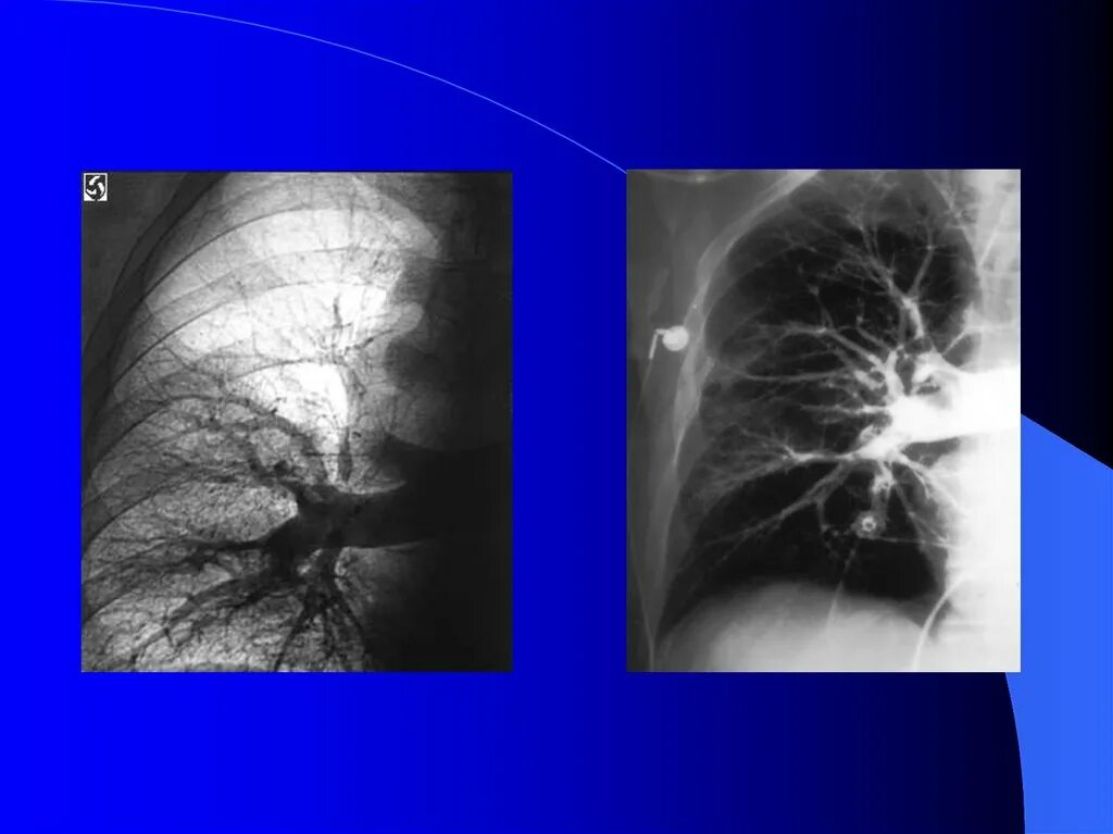 Ангиопульмонография Тэла. Массивная Тэла рентген. Легочная тромбоэмболия. Рентгенологический синдром тромбоэмболии легочной артерии:. Тромболия легочной артерии