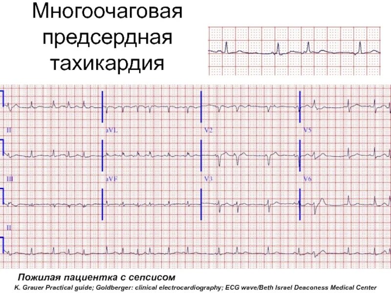 Эктопическая предсердная тахикардия. Фокусная эктопическая предсердная тахикардия экг. Фокусная предсердная тахикардия экг. Фокусная эктопическая предсердная тахикардия экг. Очаговая предсердная тахикардия на экг.